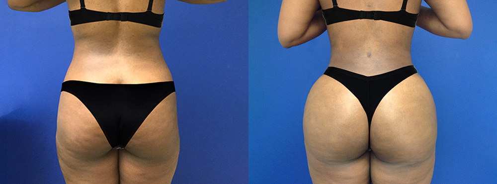 Brazilian Butt Lift Before and After