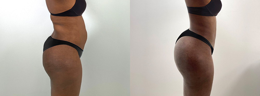 Butt Lift Before and After