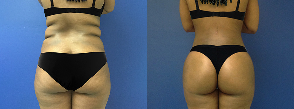 Brazilian Butt Lift Before and After
