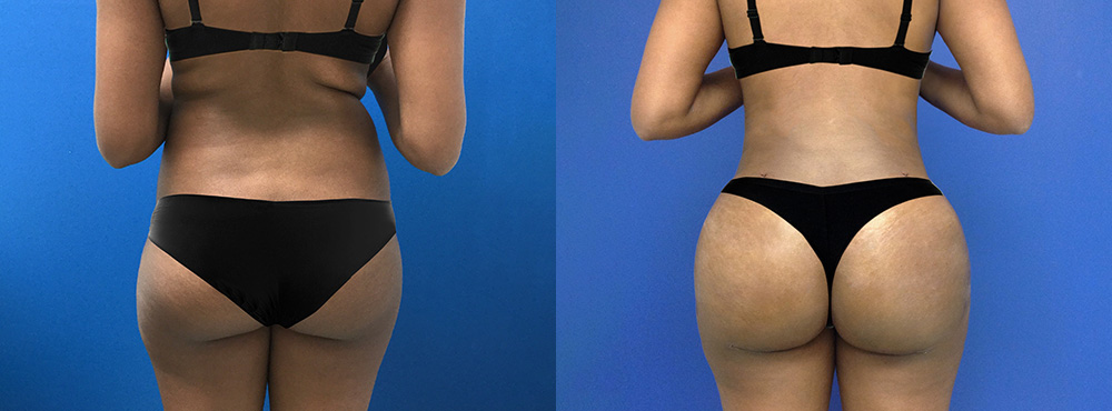 Brazilian Butt Lift Before and After 