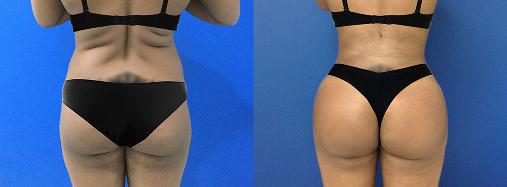 Brazilian Butt Lift Before and After