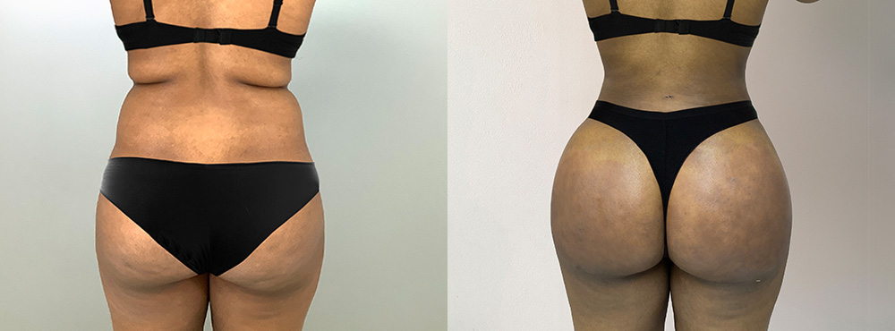 Brazilian Butt Lift Before and After