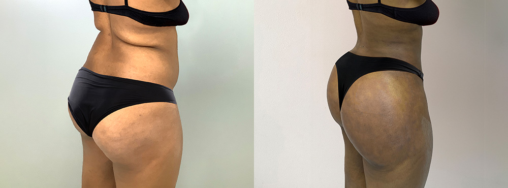 Brazilian Butt Lift Before and After