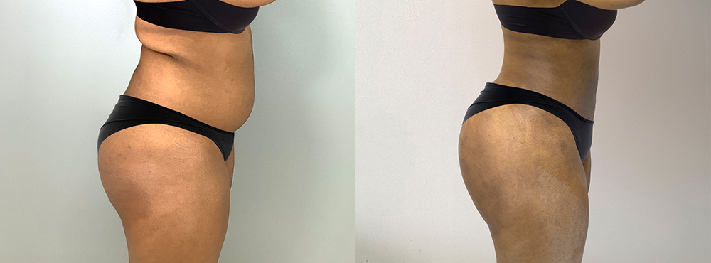 Brazilian Butt Lift Before and After
