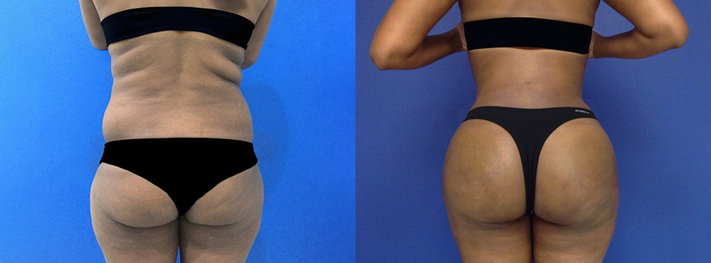 Brazilian Butt Lift Before and After in Miami