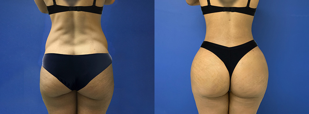 Butt Lift Before and After 