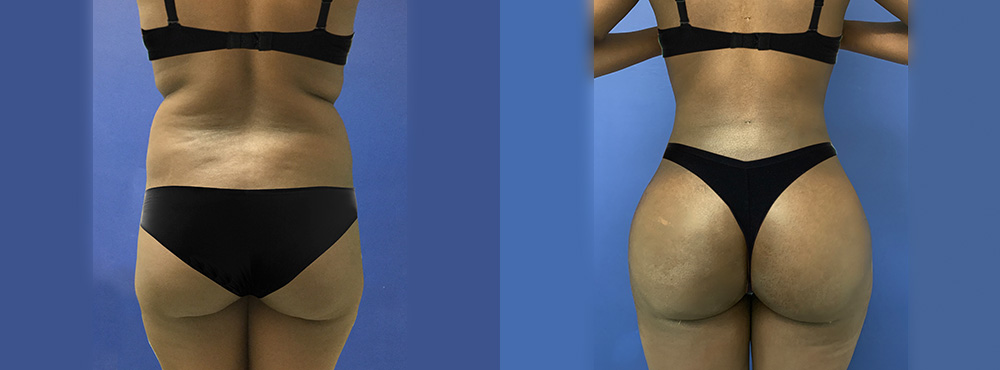 Brazilian Butt Lift before and after