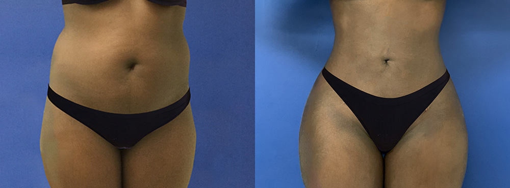 Brazilian Butt Lift before and after