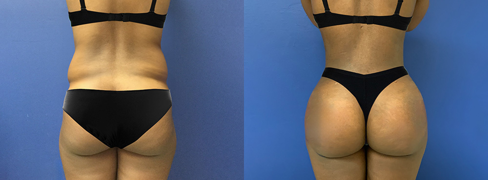 Brazilian Butt Lift Before and After