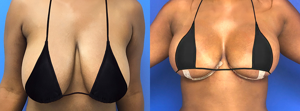 Breast Lift Before and After