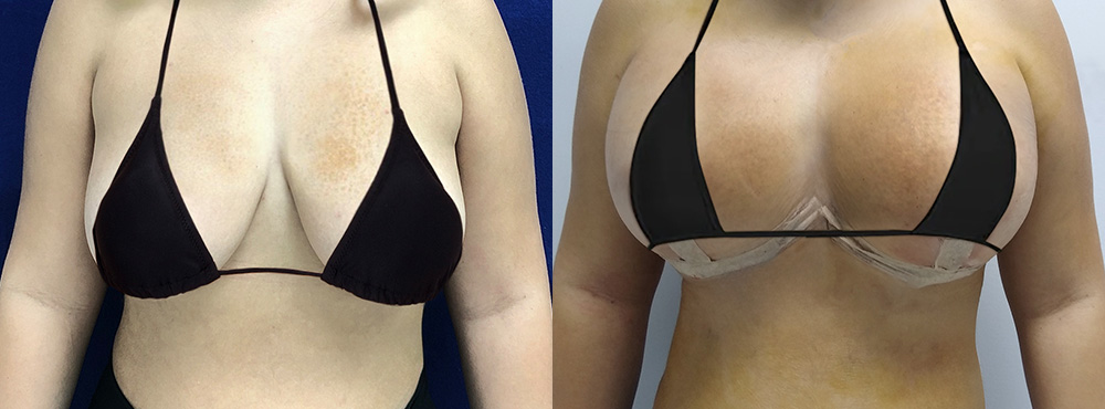 Breast Lift with implants