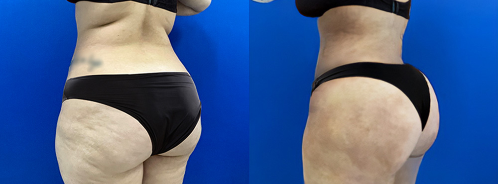Brazilian Butt Lift Before and After in Miami