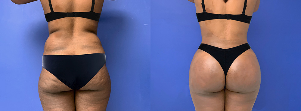 Brazilian Butt Lift Before and After