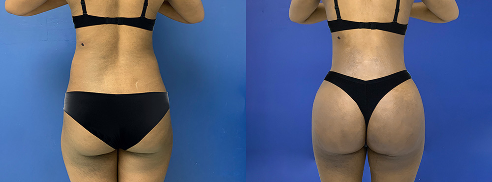 Butt Lift Before and After