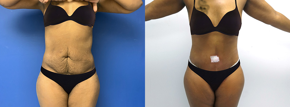 Tummy Tuck Before and After