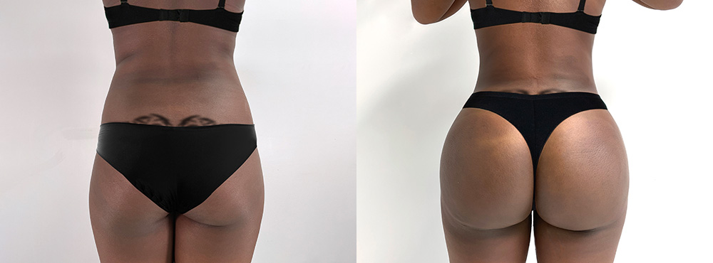 Brazilian Butt Lift before and after