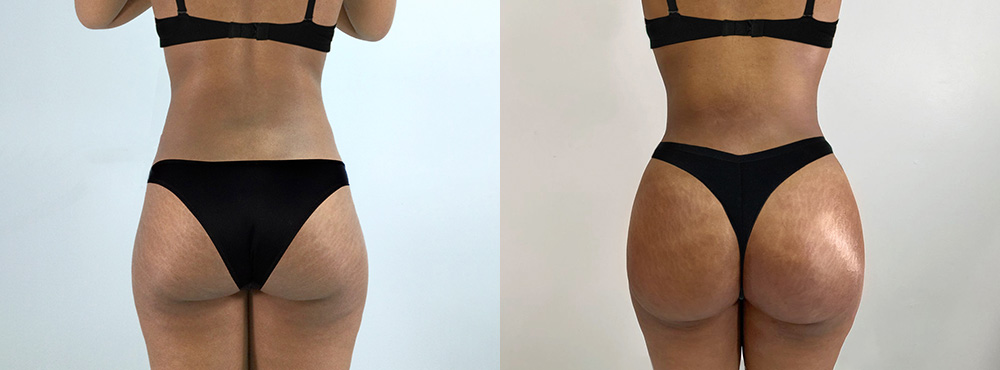 Brazilian Butt Lift Before and After