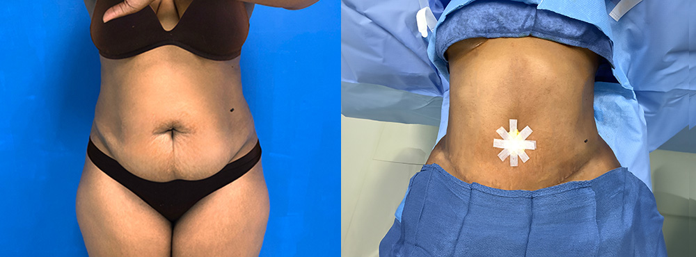 Tummy Tuck Before and After in Miami