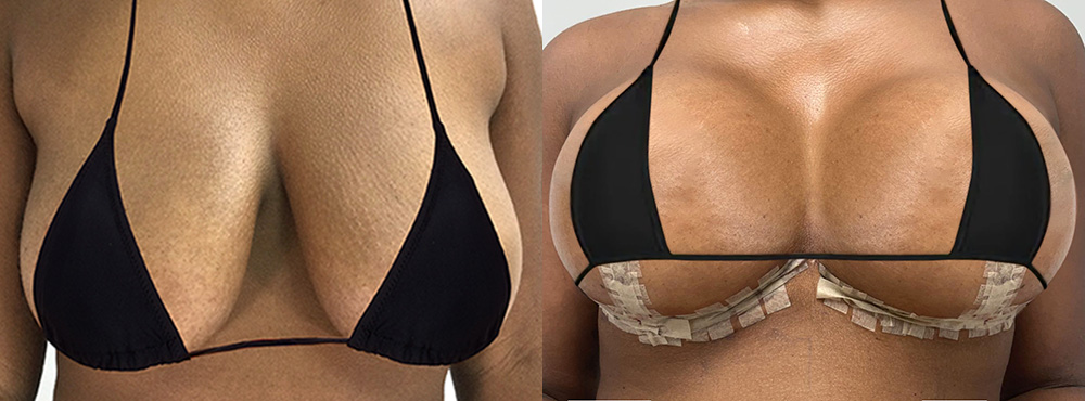 Breast Lift Before and After