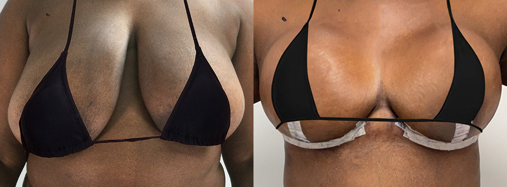 Breast Lift Before and After