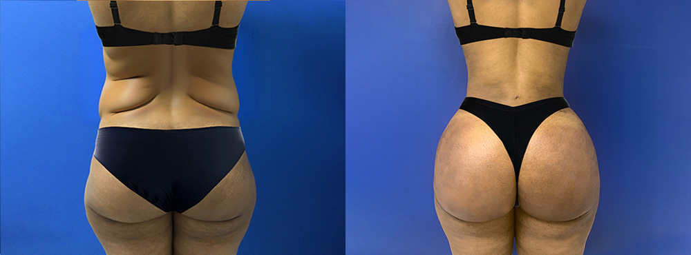 Brazilian Butt Lift Before and After