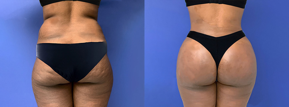 Brazilian Butt Lift Before and After