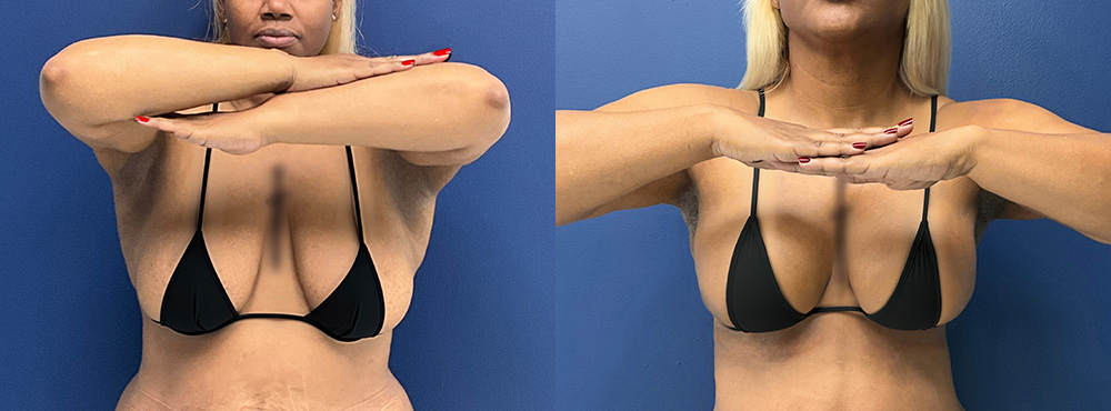Breast Lift before and after