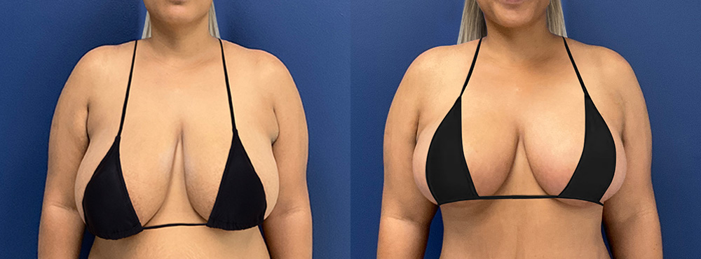 Breast Lift Before and After in Miami