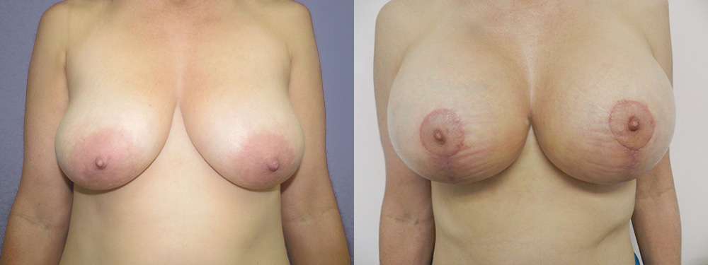Breast Lift Before and After