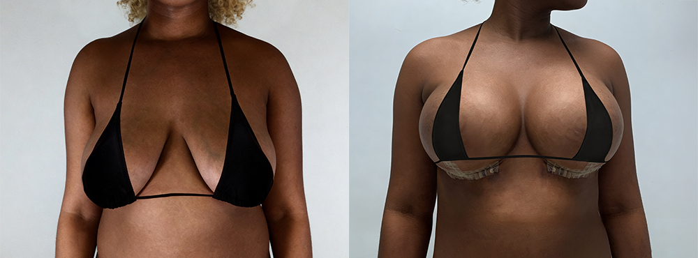 Breast Lift Before and After