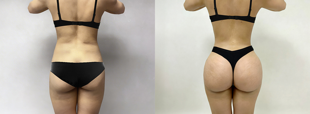 Brazilian Butt Lift Before and After