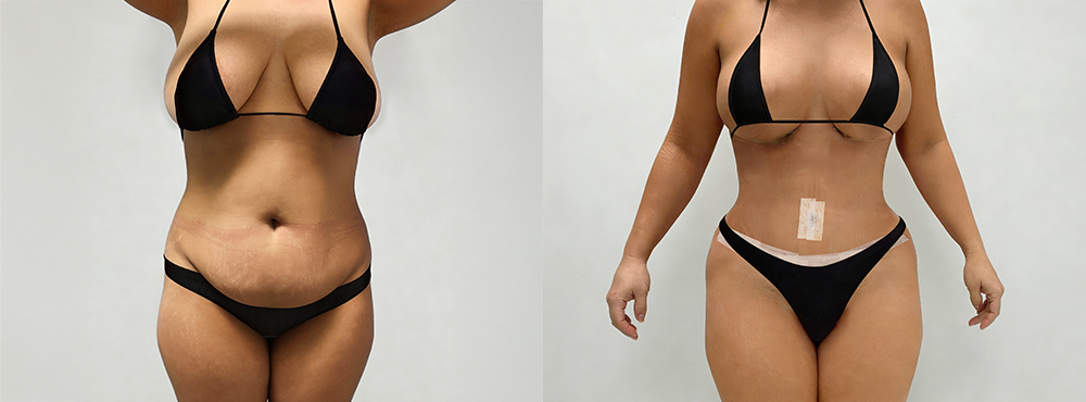 Tummy Tuck Before and After