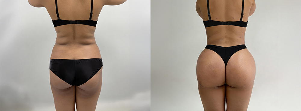 Brazilian Butt Lift Before and After
