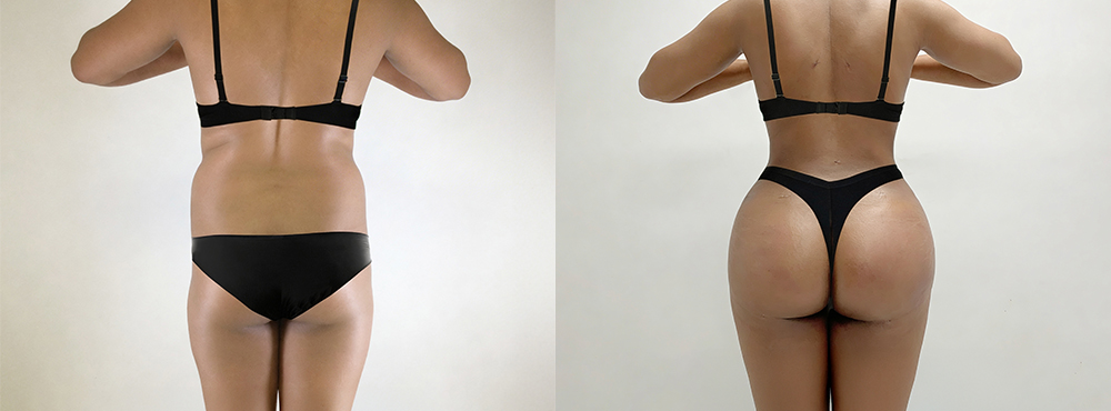 Brazilian Butt Lift Before and After