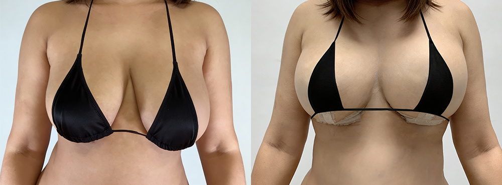 Breast Lift Before and After