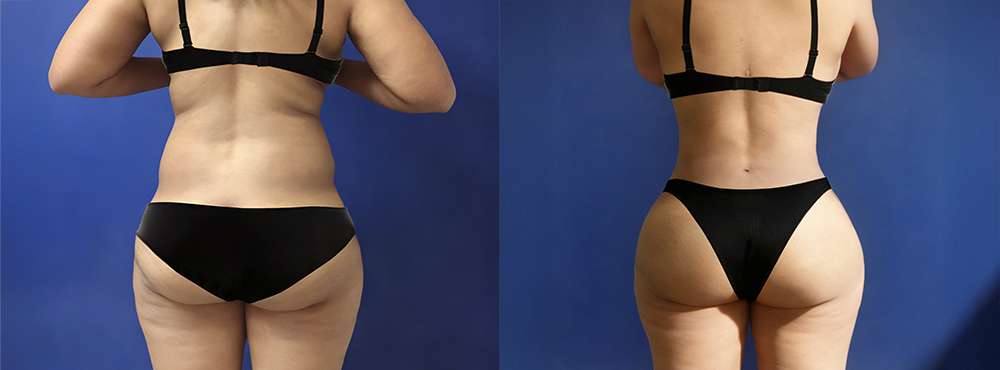 Lipo 360 Before and After