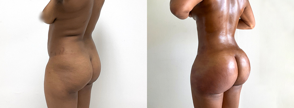 bbl before and after photos