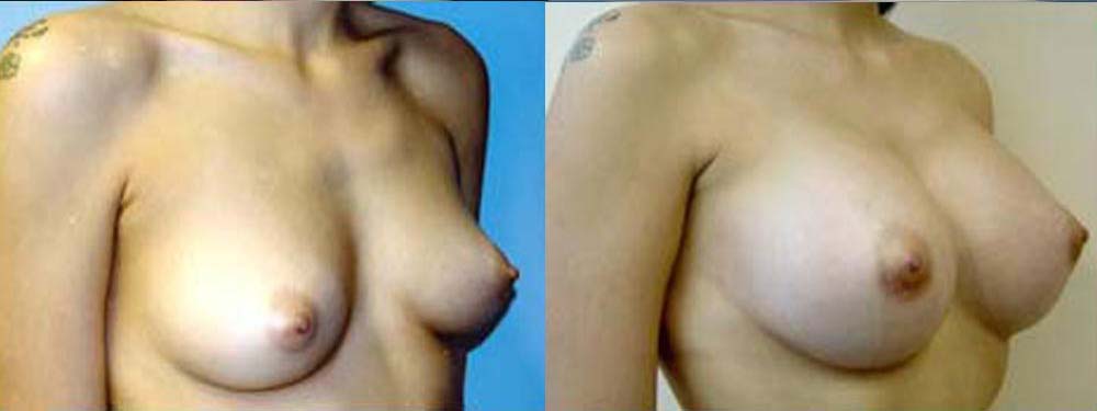 breast augmentation before and after