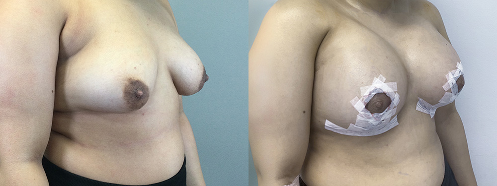 breast lift before and after photos