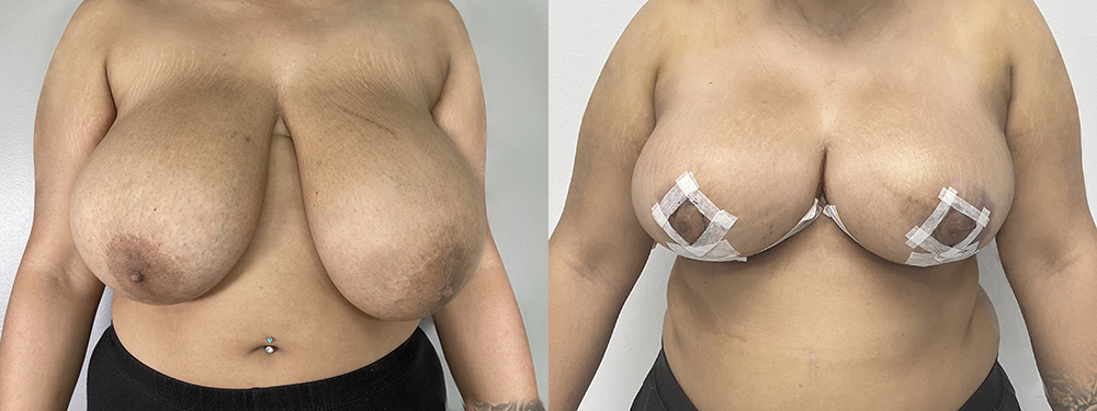 breast reduction before and after photos