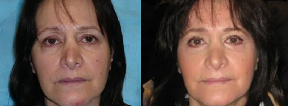 Face Lift before and after photos