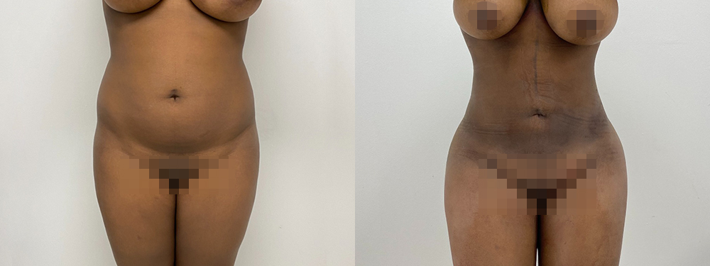 liposuction before and after photos