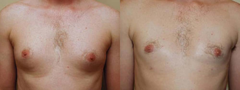 breast reduction before and after photos