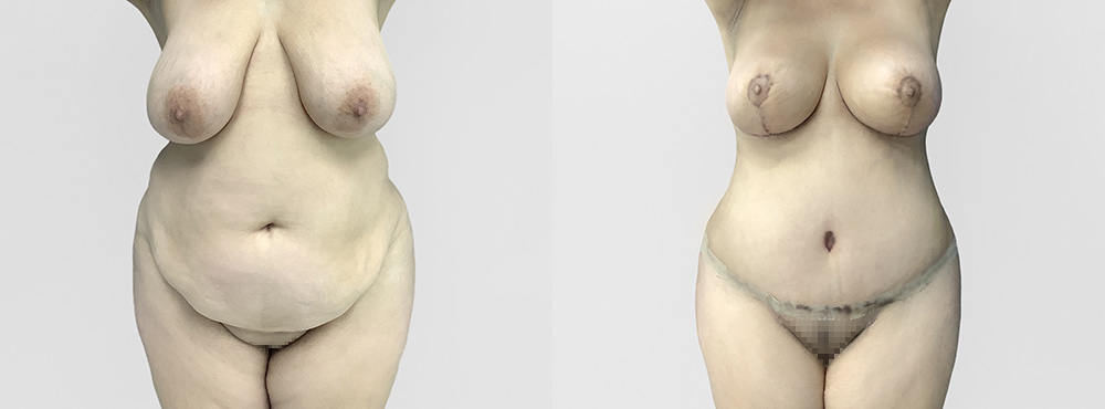 mommy makeover before and after photos