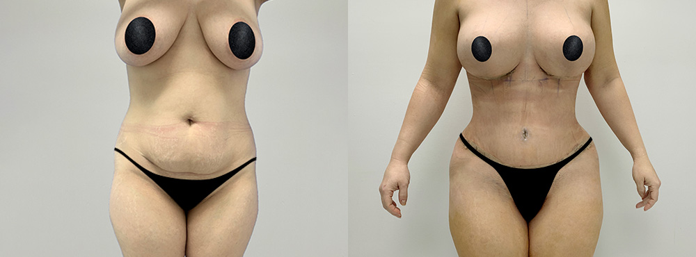 mommy makeover before and after photos