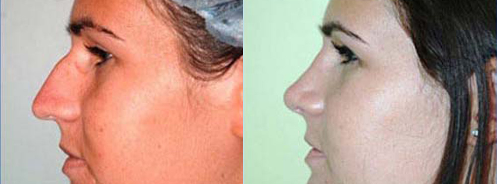 rhinoplasty before and after photos