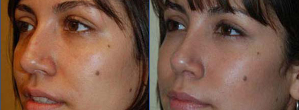 rhinoplasty before and after photos