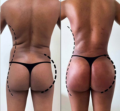 body instagram post tummy tuck