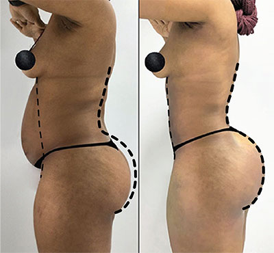 body instagram post skinny bbl